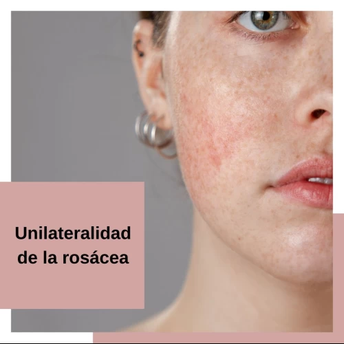 Unilateralidad de la rosácea: Comprender por qué la afección afecta solo un lado de la cara y cómo manejarla