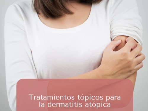 Tratamientos tópicos para la dermatitis atópica