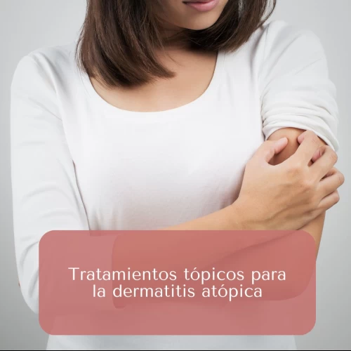 Tratamientos tópicos para la dermatitis atópica