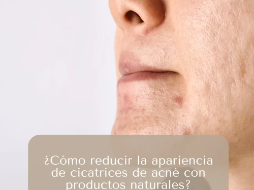 ¿Cómo reducir la apariencia de cicatrices de acné con productos naturales?