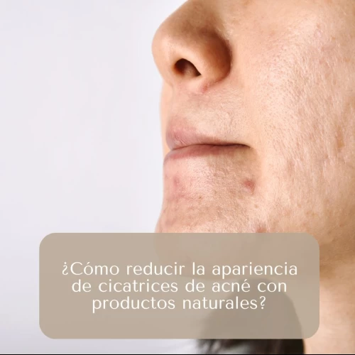 ¿Cómo reducir la apariencia de cicatrices de acné con productos naturales?