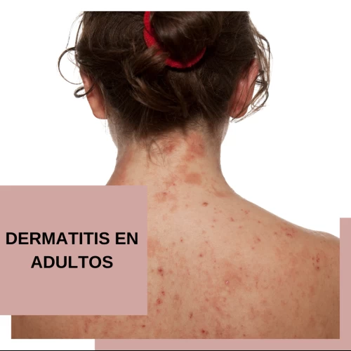 Dermatitis atópica en adultos: Causas, síntomas y tratamiento